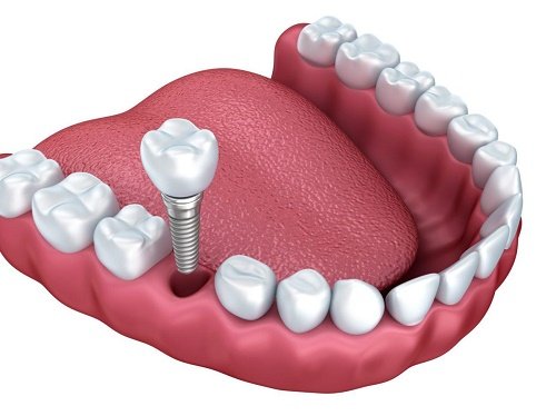 Các hình thức làm răng sứ cercon phổ biến 4