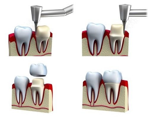Làm răng sứ có đau không khi bị hô răng? 2