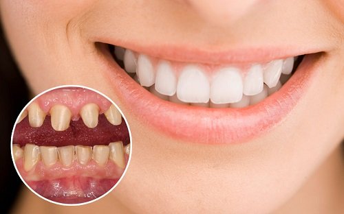 Làm răng sứ có đau không khi bị hô răng? 3