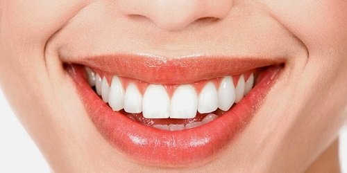 Làm răng sứ có niềng răng được không? Cần làm gì? 1