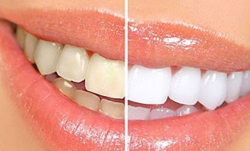 Làm răng sứ không mài răng cho răng bị nhiễm màu nặng 