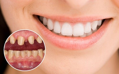 Răng bị hô thì làm răng sứ mất bao lâu? 1
