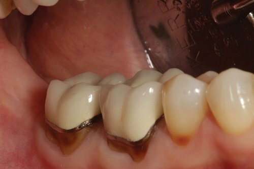 Giải quyết vấn đề răng sứ bị hở sau khi áp dụng 1
