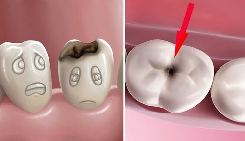 Răng sứ bị sâu không sau khi tiến hành bọc sứ? 1