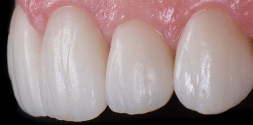 Răng sứ bị sưng lợi khi lắp - nguyên nhân bạn cần tránh 1