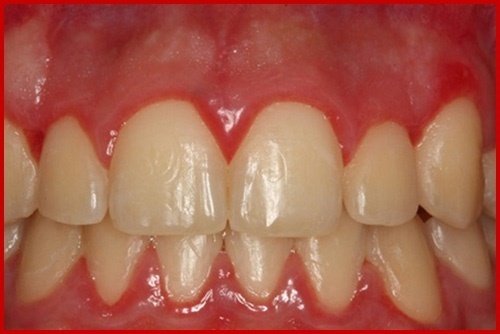 Răng sứ bị sưng lợi khi lắp - nguyên nhân bạn cần tránh 2