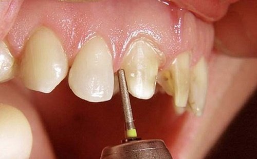 Răng sứ có mài được không? Làm gì bị răng bị gãy? 3