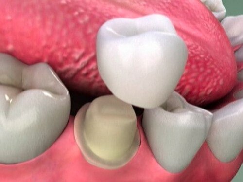 Răng sứ có tháo ra được không khi bị gãy? 1