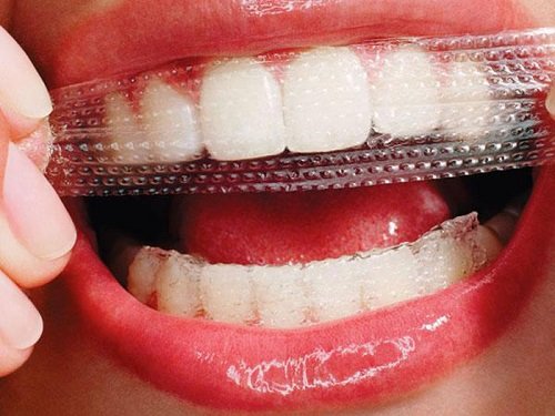 Miếng dán tẩy trắng răng loại nào tốt? Được sử dụng ra sao 3