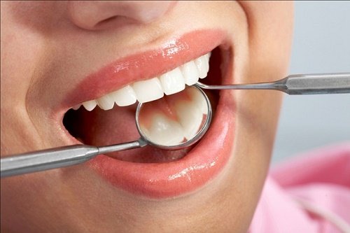 Những ưu điểm công nghệ tẩy trắng răng brite smile 2