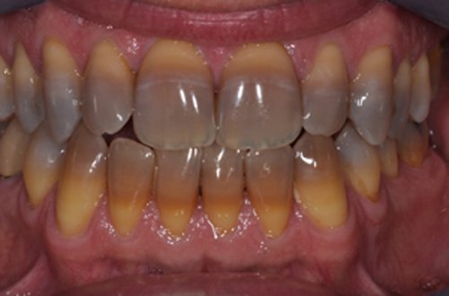 Tác hại của việc tẩy trắng răng sai cách là gì? 1