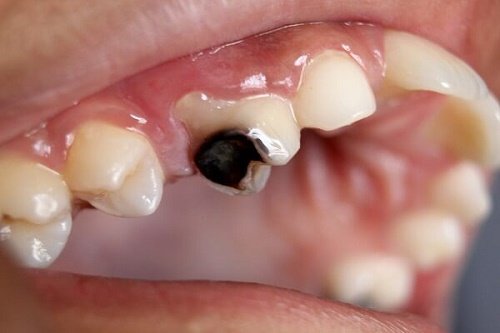 Nhổ răng sâu ở đâu an toàn hiệu quả cao? 1