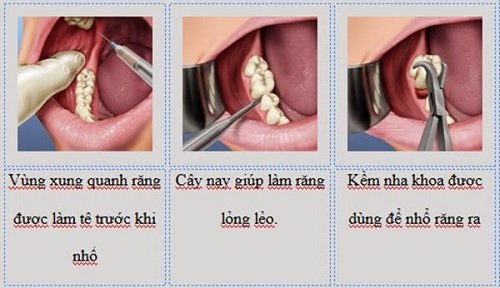 Nhổ răng sâu ở đâu an toàn hiệu quả cao? 2