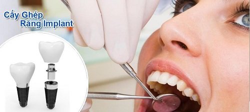 Trồng răng bị rụng - Kỹ thuật phục hình nào phù hợp? 1
