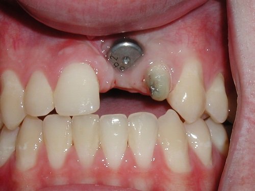 Trồng răng cửa hàm trên - Phục hình thẩm mỹ cho bạn 1
