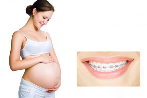 Niềng răng bao lâu thì nên có bầu? Bác sĩ chuyên khoa tư vấn *
