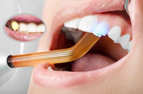 Trồng răng khểnh có đau không? Tìm hiểu ngay cách thực hiện 2