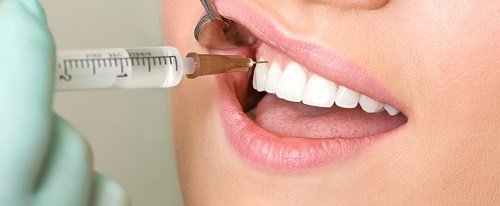 Trồng răng khểnh có đau không? Tìm hiểu ngay cách thực hiện 3