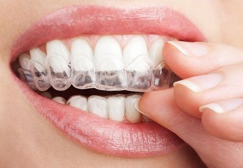 Niềng răng invisalign có nhổ răng không? Tư vấn niềng răng 1