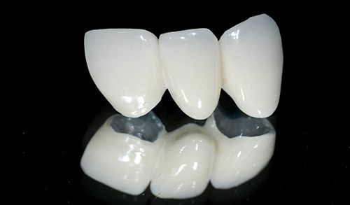 Có nên trồng răng sứ kim loại không? Giải đáp từ bác sĩ *