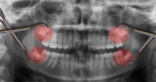 Răng khôn hàm trên bị sâu - Xử lý hiệu quả dứt điểm 1