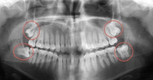 Răng khôn hàm trên bị sâu - Xử lý hiệu quả dứt điểm 3