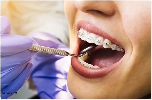 Niềng răng dùng bàn chải gì? Các loại bàn chải cần tham khảo 1