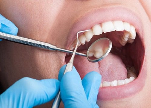 Lấy cao răng có ảnh hưởng không? Nên thực hiện không? 2