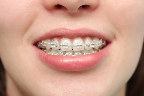 Niềng răng hô hàm trên bao nhiêu tiền? Chi phí nha khoa 1
