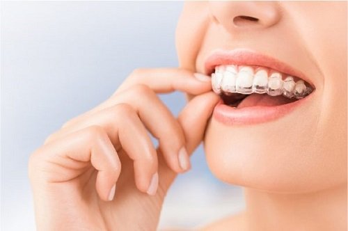 Niềng răng hô hàm trên bao nhiêu tiền? Chi phí nha khoa 3