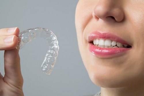 Niềng răng hơi hô mất bao lâu? Thông tin từ nha khoa 2