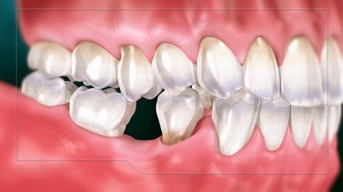 Trồng răng giả hàm dưới cần phải tham khảo kiến thức gì? 1