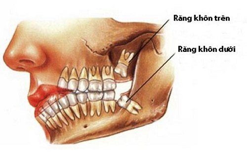 Răng khôn không đau có cần nhổ không? Bác sĩ giải đáp 1