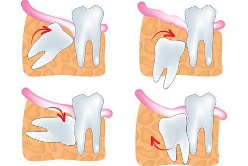 Răng khôn không đau có cần nhổ không? Bác sĩ giải đáp 3