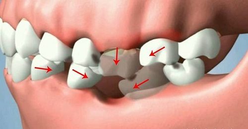 Trồng răng hàm dưới cần nắm bắt những thông tin nào? 2