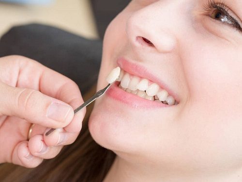 Trồng răng khểnh ở đâu đảm bảo hiệu quả cao? 2