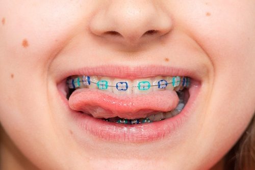 Niềng răng cho trẻ 10 tuổi có tốt không? 1