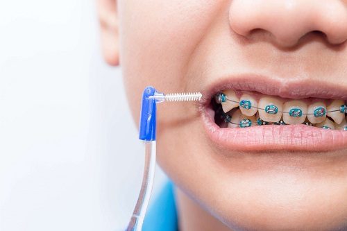 Niềng răng cho trẻ 10 tuổi có tốt không? 2