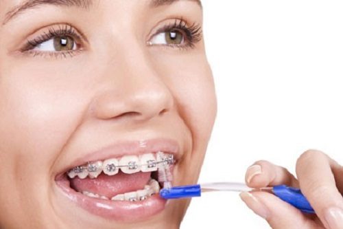 Niềng răng cho trẻ 10 tuổi có tốt không? 3