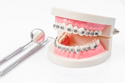 Niềng răng có hại cho sức khỏe không? Thực hư vấn đề này 1