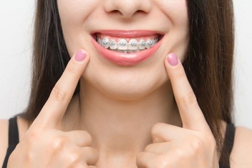 Niềng răng có hại cho sức khỏe không? Thực hư vấn đề này 2