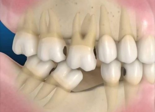 Trồng răng giả có lâu không? Tham khảo ý kiến bác sĩ 2