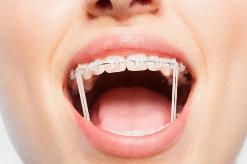 Trồng răng giả có niềng được không? Tìm hiểu ngay 1