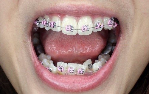 Niềng răng giúp điều chỉnh răng không đều hiệu quả*