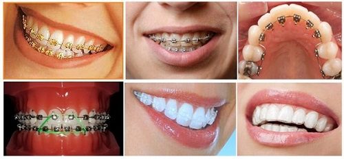Niềng răng không đều - Giải pháp từ nha khoa 2