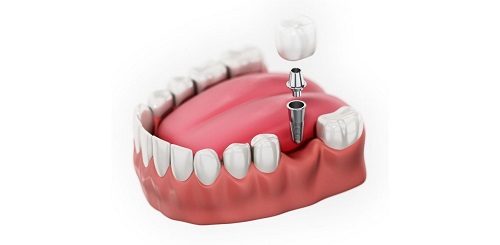 Trồng răng cối khắc phục các tình trạng nào trên răng? 1