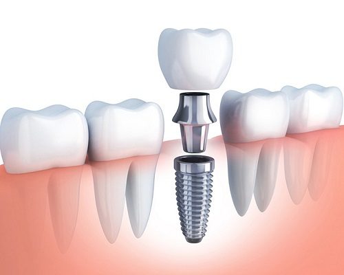 Trồng răng cối khắc phục các tình trạng nào trên răng? 2