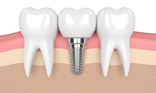 Trồng răng cối khắc phục các tình trạng nào trên răng? 3