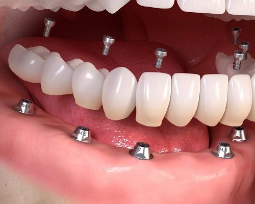 Trồng răng hàm implant giá bao nhiêu? Cập nhật giá mới trong năm 1