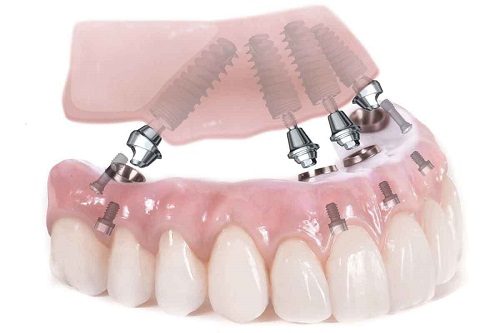 Trồng răng hàm implant giá bao nhiêu? Cập nhật giá mới trong năm 2